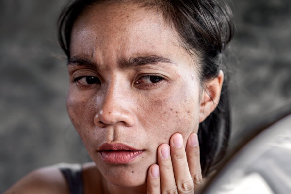 Dermatologist in Chandigarh
