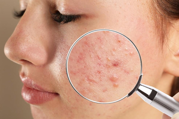 Dermatologist in Chandigarh