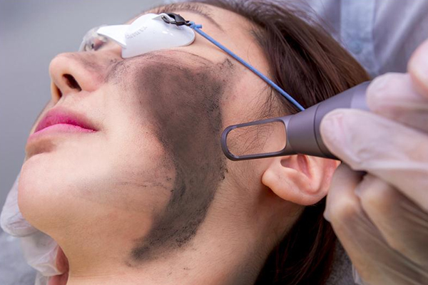 The Best Acne & Pimple Treatments in Chandigarh: From Peels to Laser