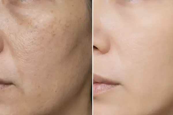 Pigmentation & Melasma Solutions: Professional Options That Work